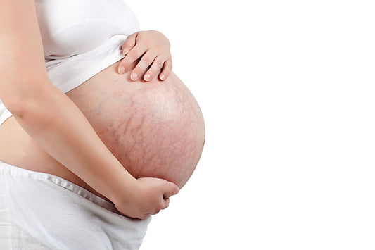 Stretch Marks 101